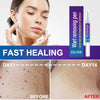Wart & Verruca Removal Pen – Fast Acting Liquid Treatment for Clear, Healthy Skin