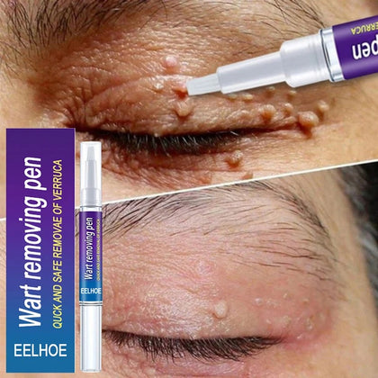 Wart & Verruca Removal Pen – Fast Acting Liquid Treatment for Clear, Healthy Skin